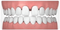 Dientes separados