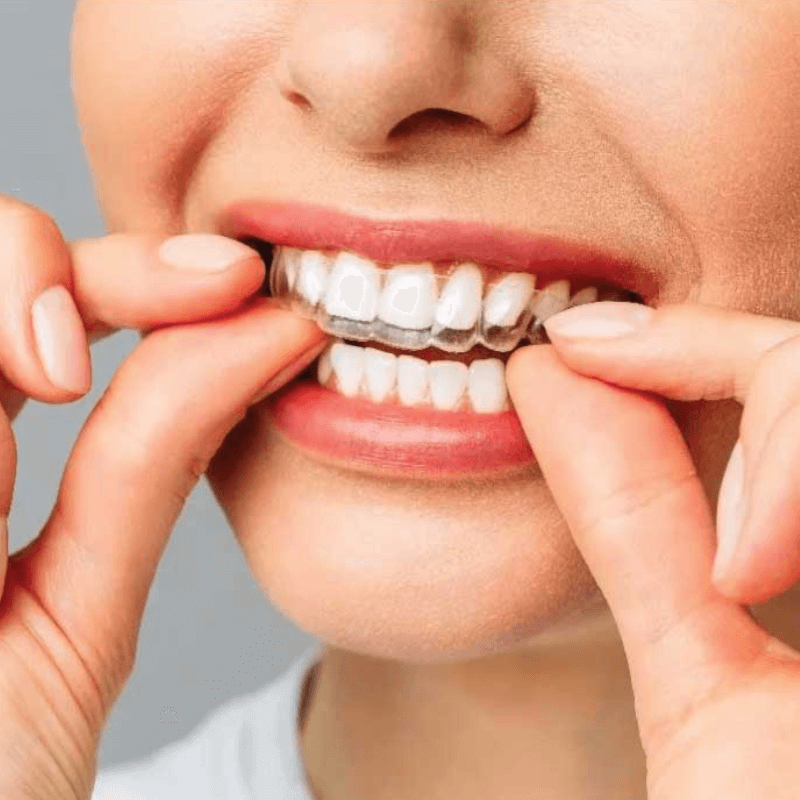 Invisalign